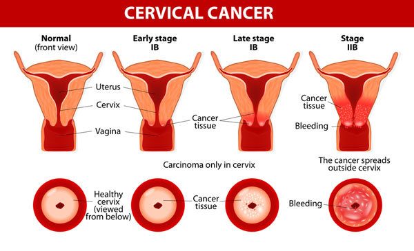 Cervical cancer - มะเร็งปากมดลูก